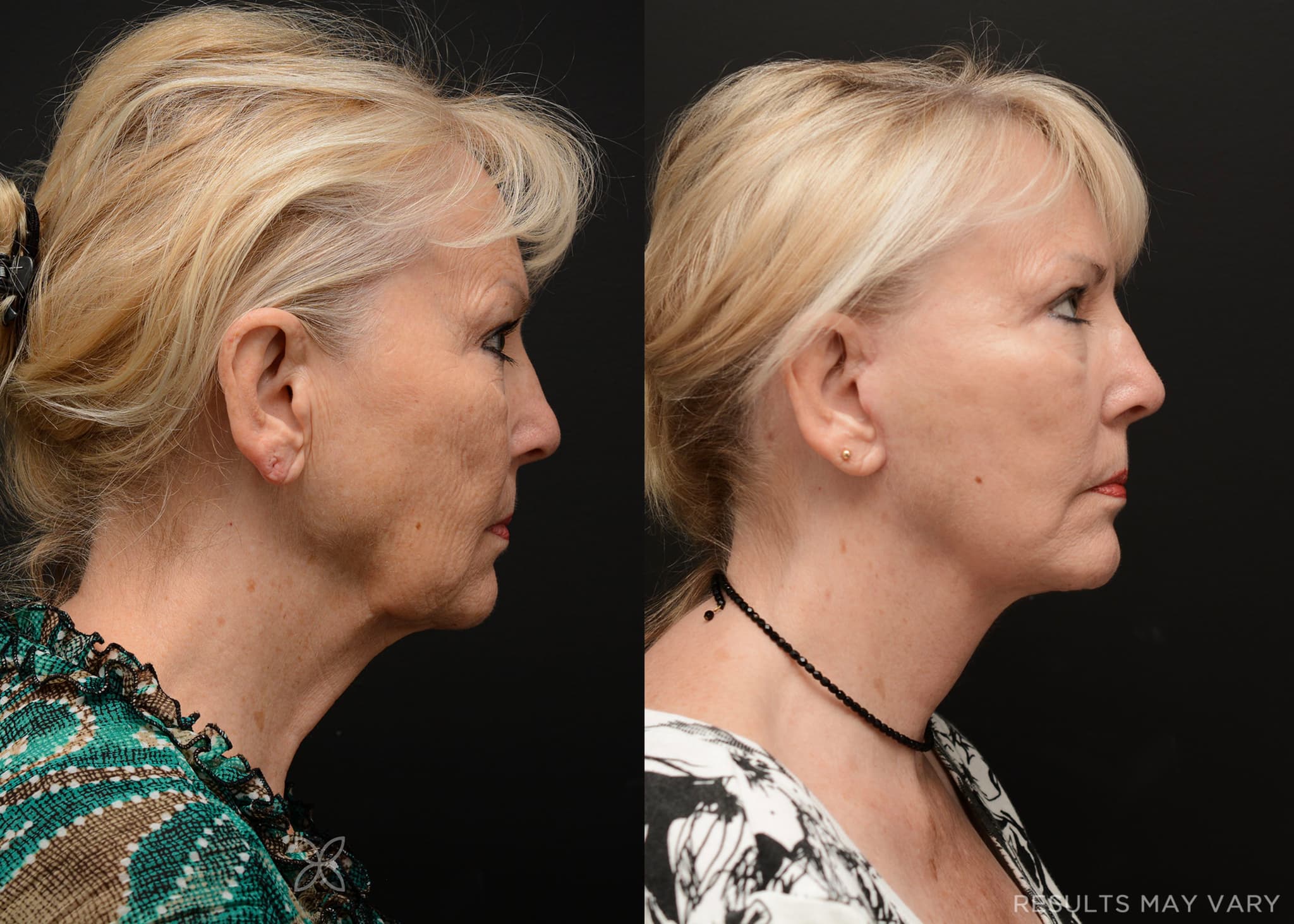 Facelift
