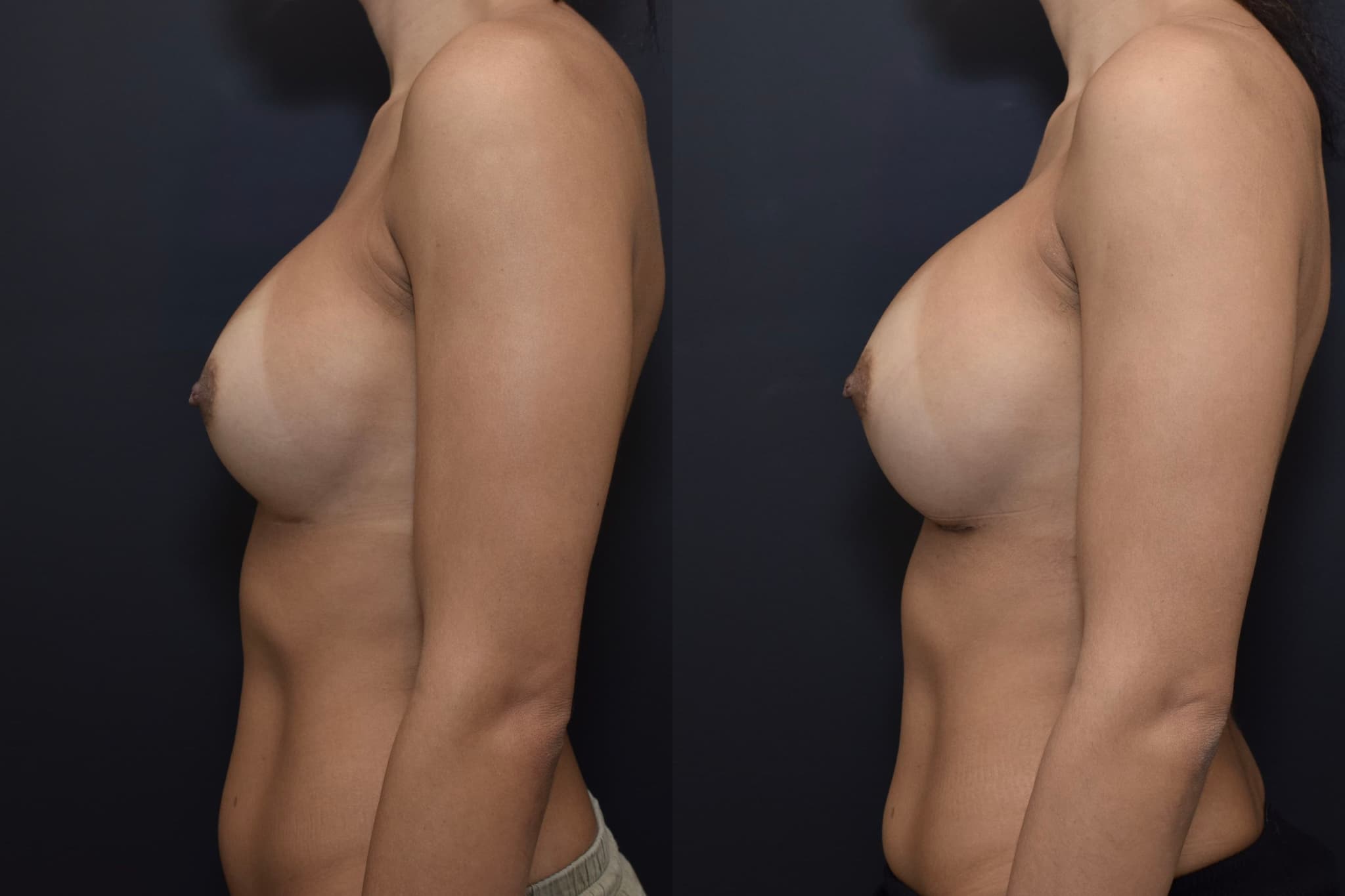 Breast Augmentation