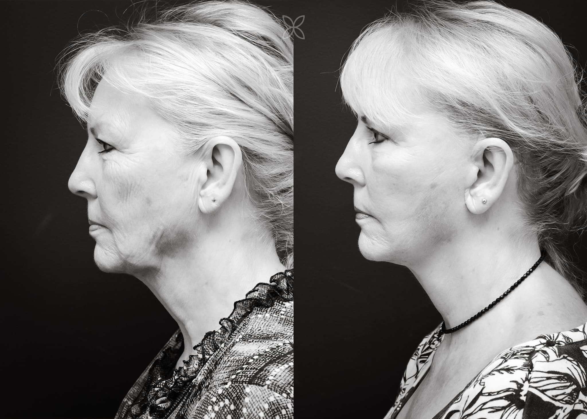 Facelift