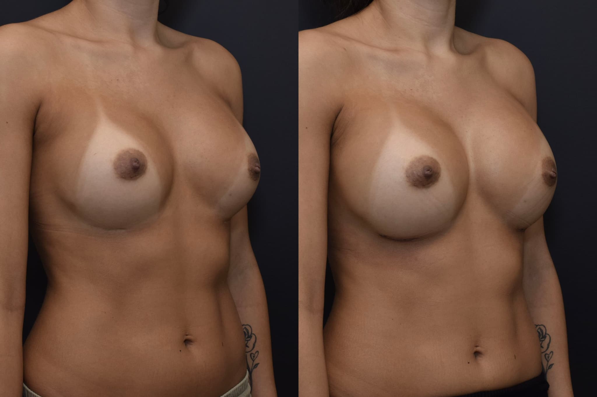 Breast Augmentation