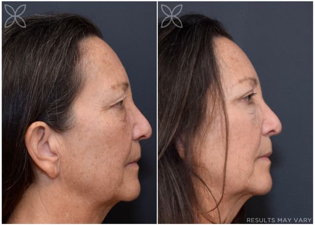 Upper Eyelids