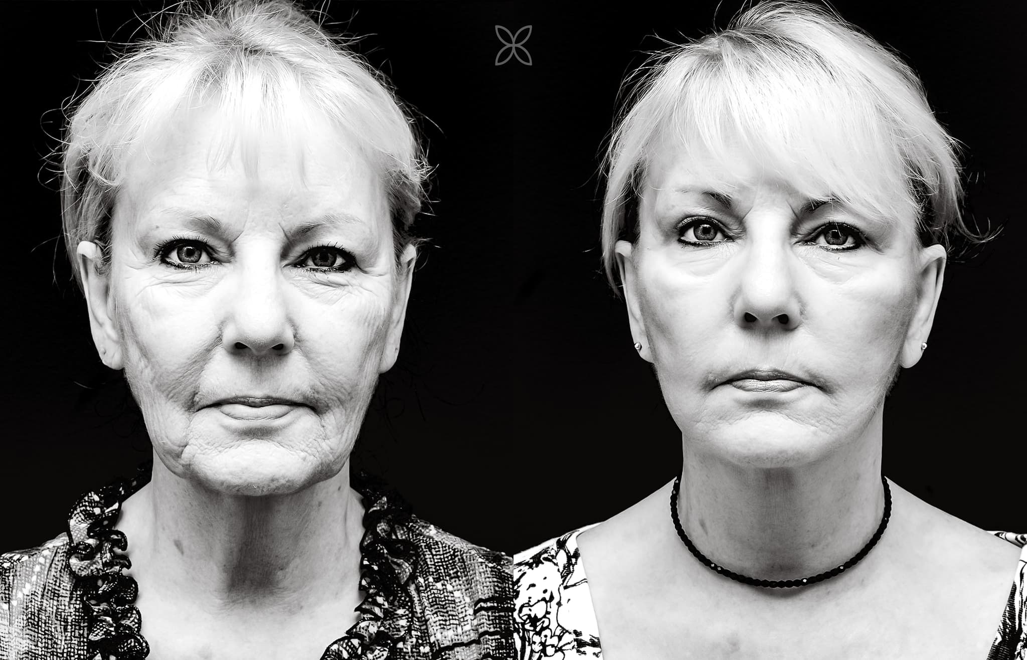 Facelift 