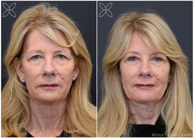 Upper Eyelids