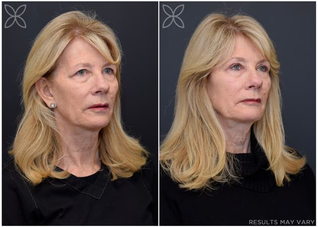 Upper Eyelids