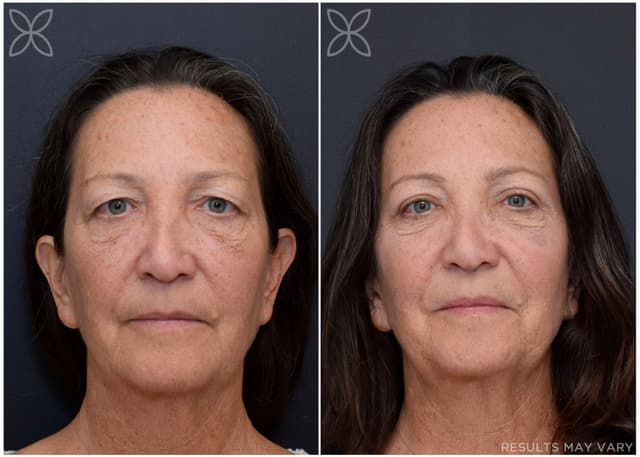 Upper Eyelids
