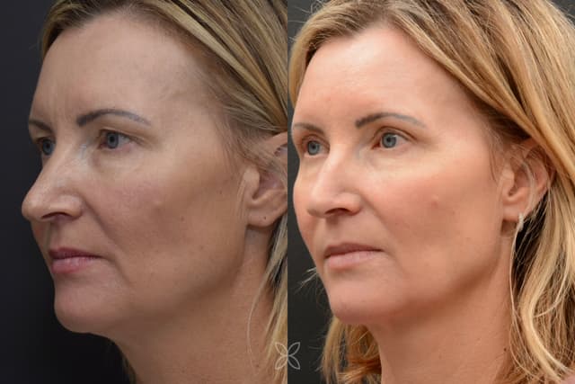 Upper Eyelids