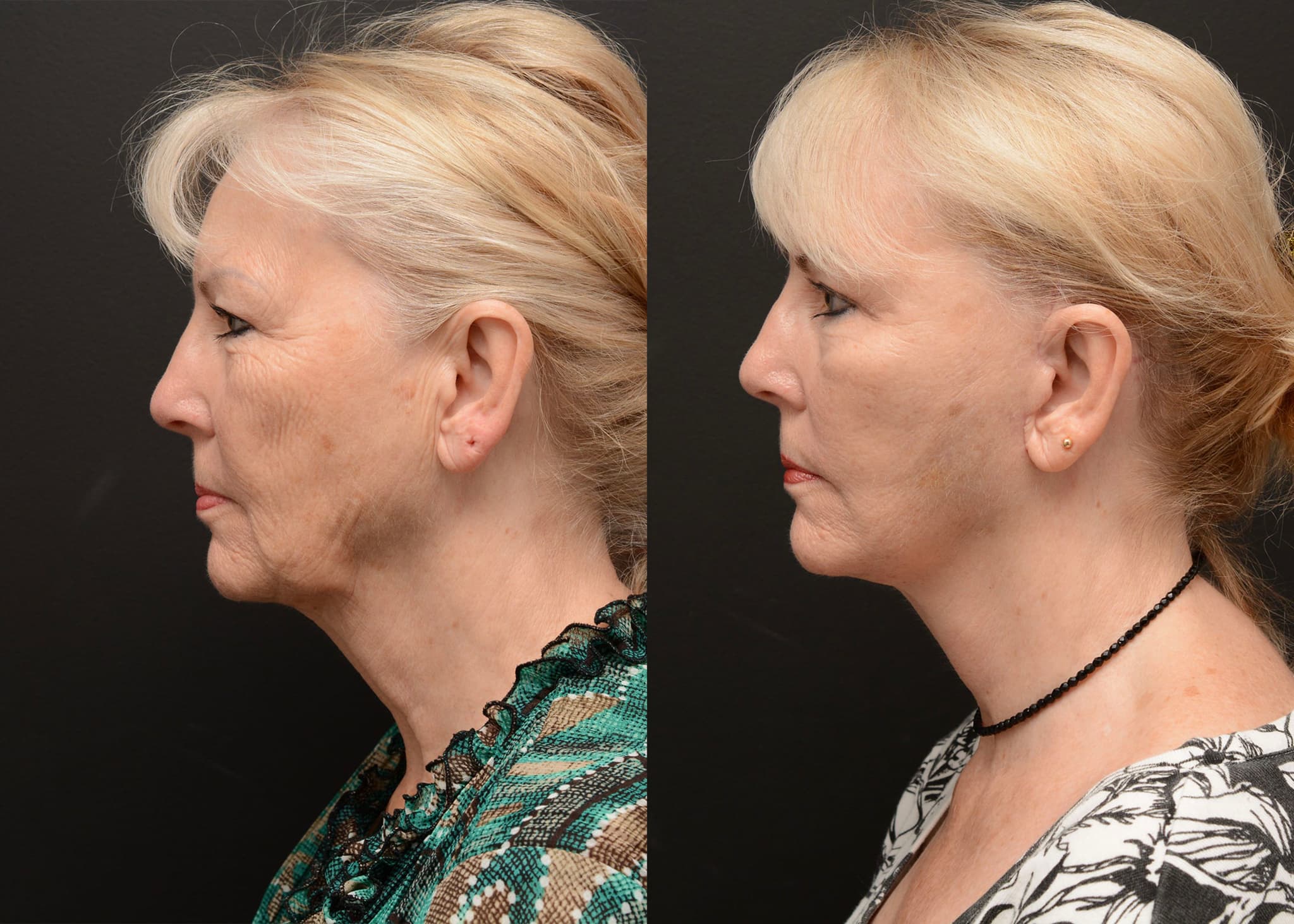 Facelift