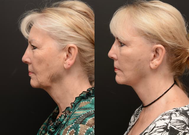 Facelift