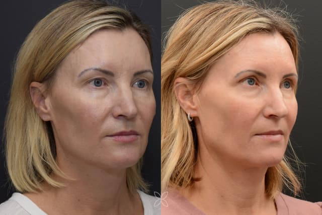 Upper Eyelids