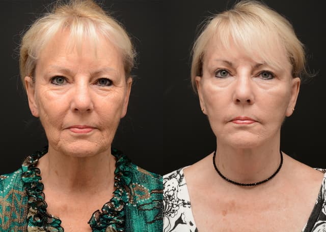 facelift