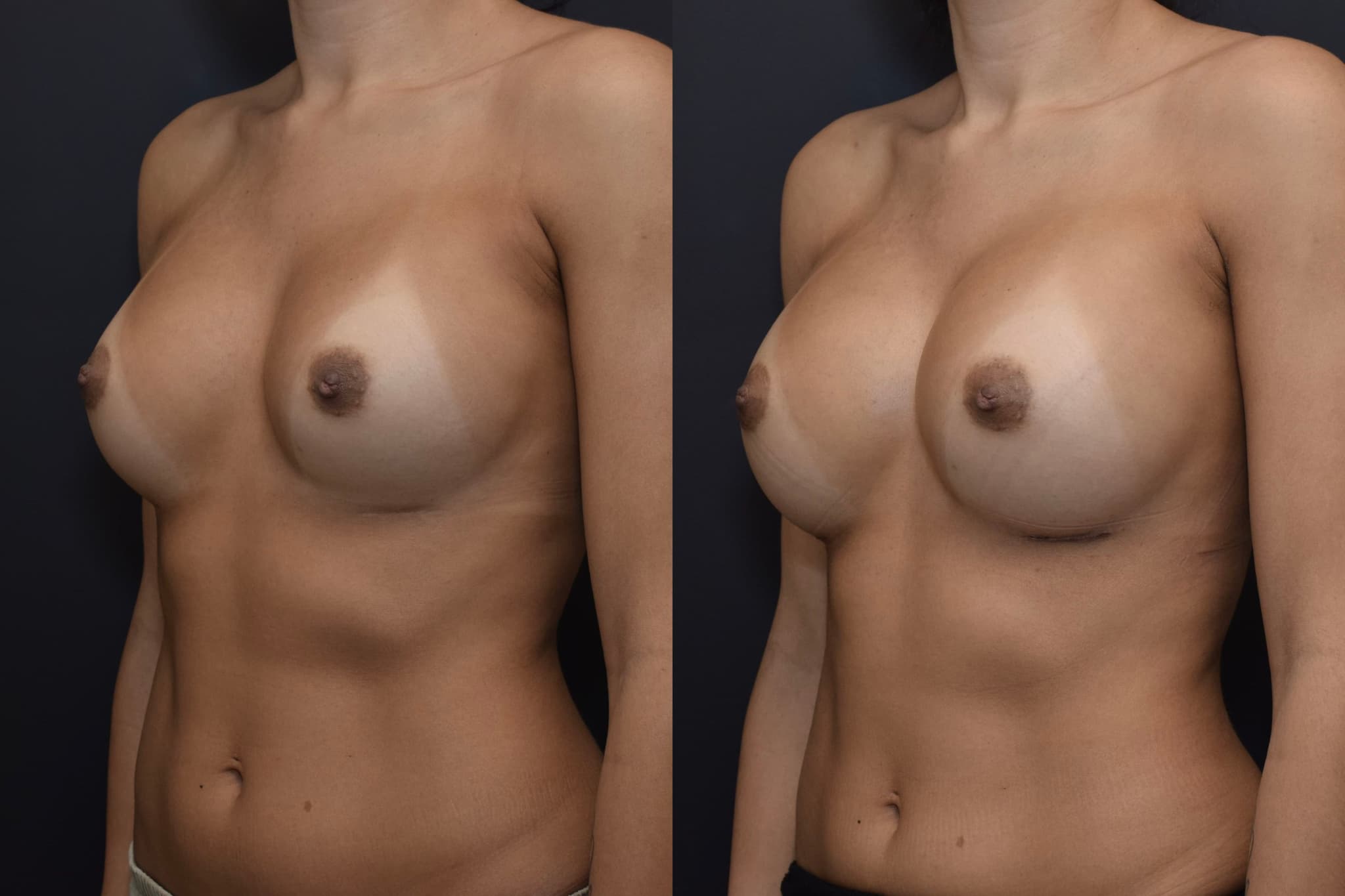 Breast Augmentation