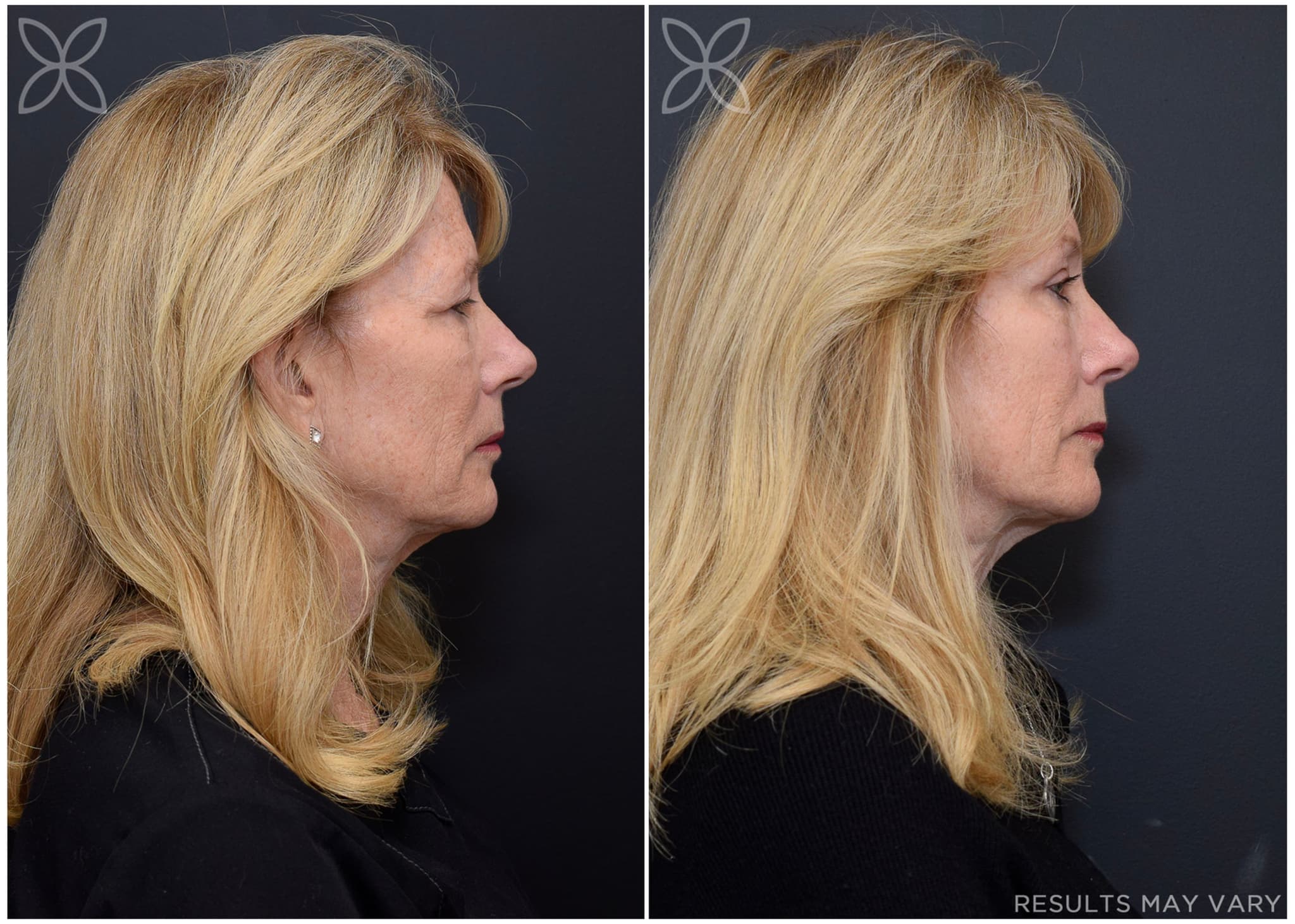 Upper Eyelids