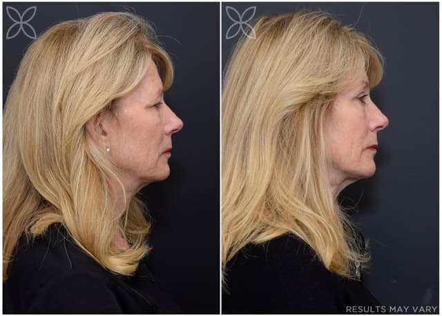 Upper Eyelids