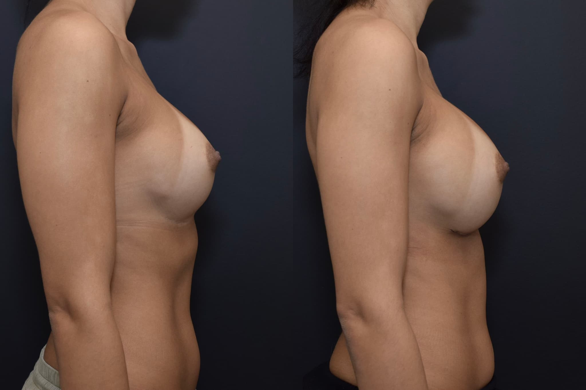 Breast Augmentation