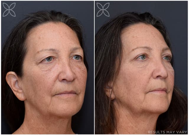 Upper Eyelids