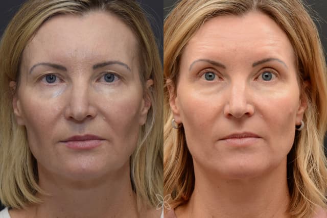 Upper Eyelids